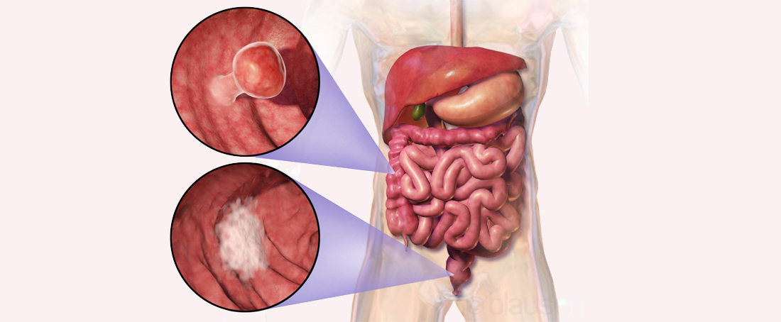 Microbiome and colon cancer