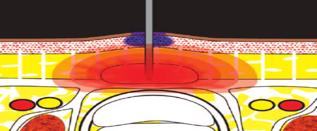 Collagenase role in skin ulcer therapy