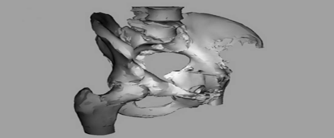 Tissue engineering approaches for treating bone defects 