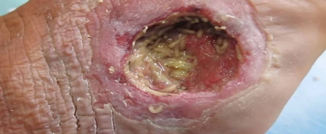 Maggot therapy for the treatment of chronic wounds 