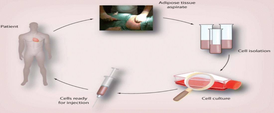 Isolation and transplantation of stem cells to treat immunodeficiency disorders