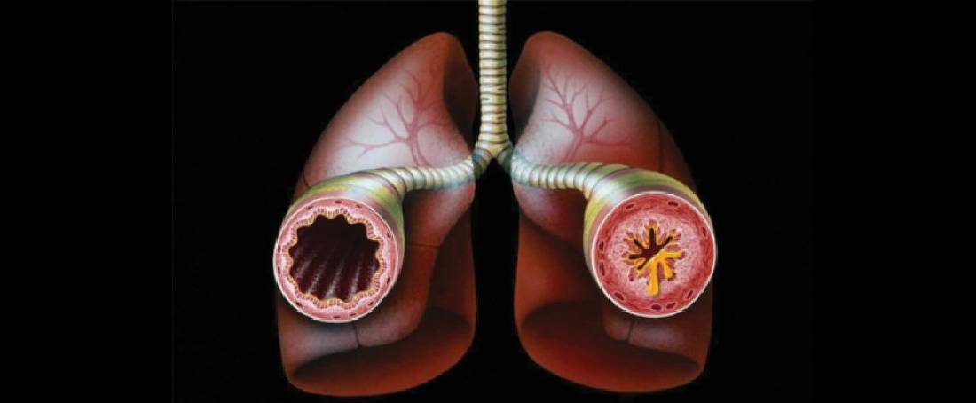 An understanding of the MUC5AC gene expression in asthma