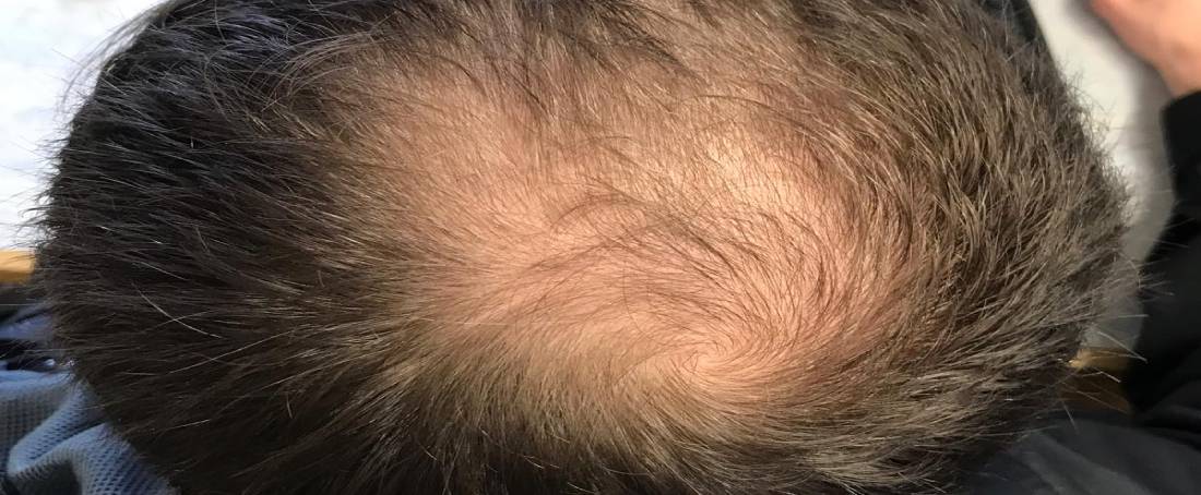 The fine-tuning of stem cell metabolism to prevent hair loss