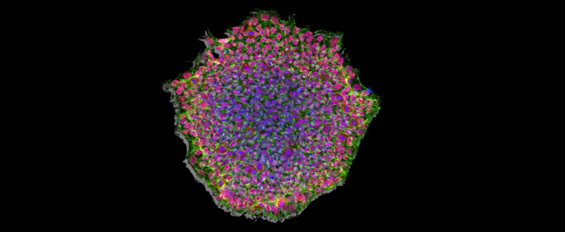 A new hope being given by induced pluripotent stem cells in cancer treatment
