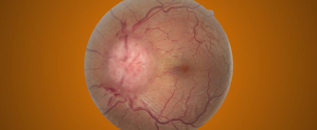 Stem cells based retinal tissue engineering for curing visual impairment