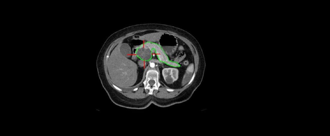 siG12D-LODER for pancreatic cancer
