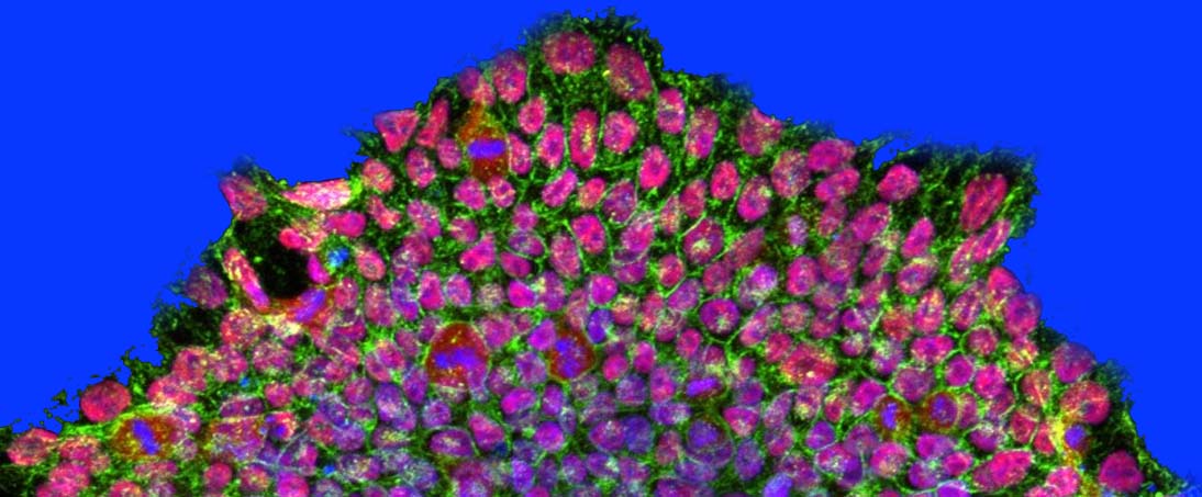 Induced pluripotent cells for modelling of Parkinson